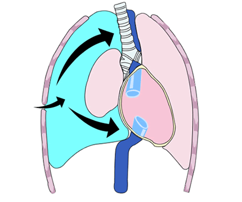Tension Pneumothorax Tension Pneumothorax